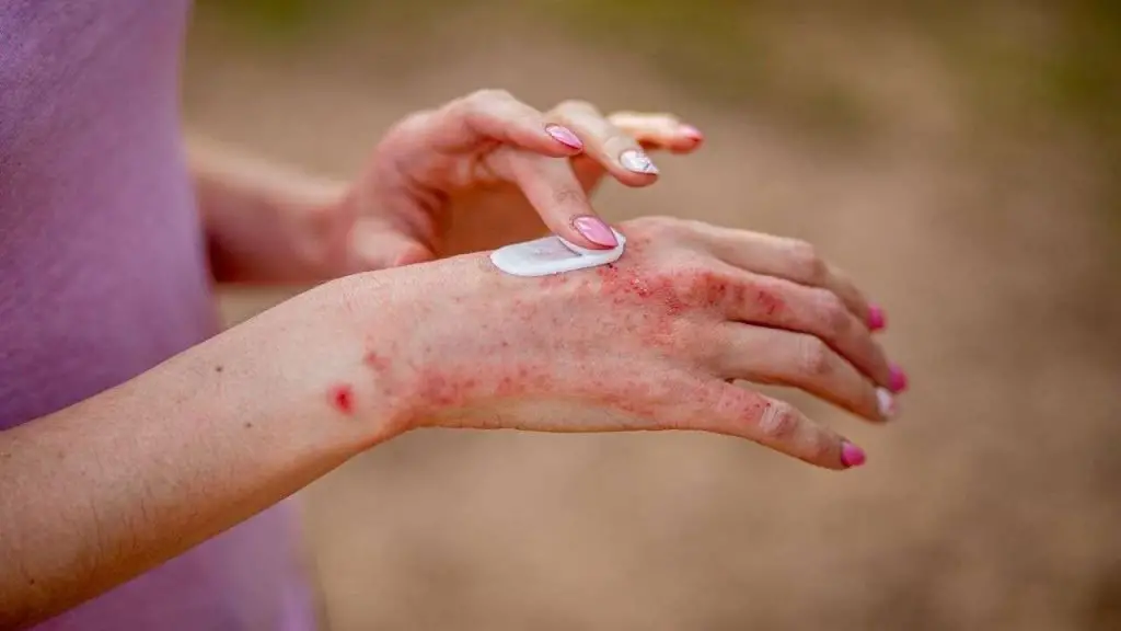 skin disease
