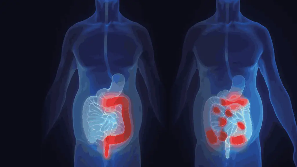 Sea Moss for Crohn's Disease