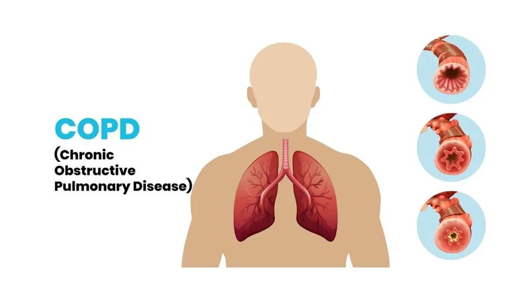 COPD disease