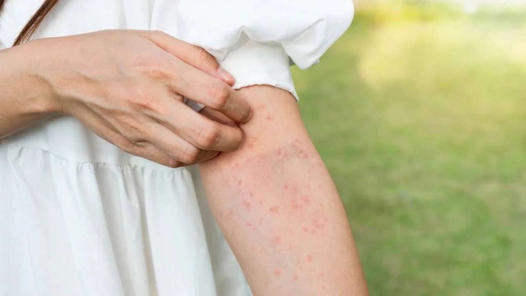 allergy