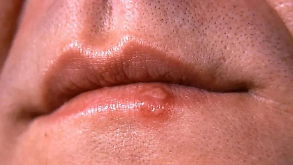 signs of herpes