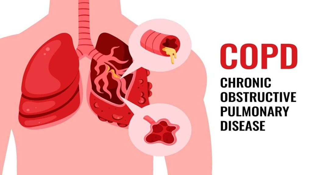 COPD disease