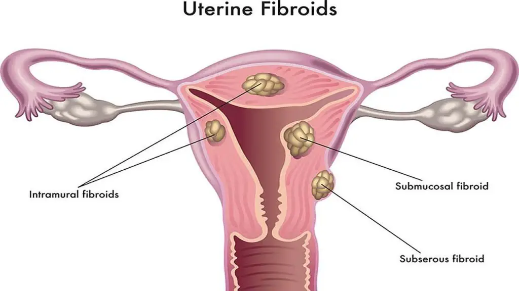 fibroids disease